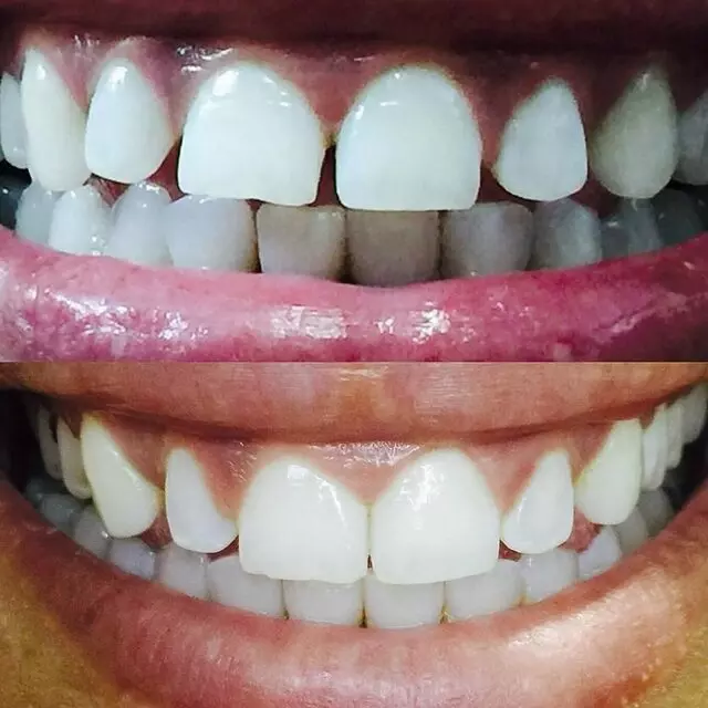 Smile Direct Club
